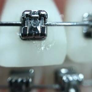 damon braces, orthodontics