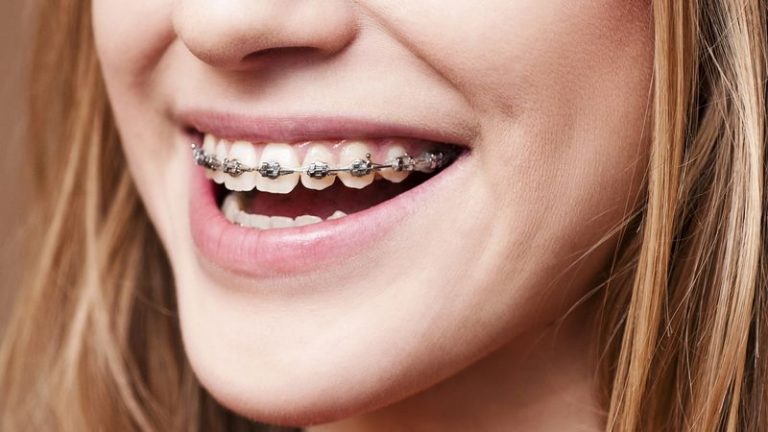 Are braces painful?