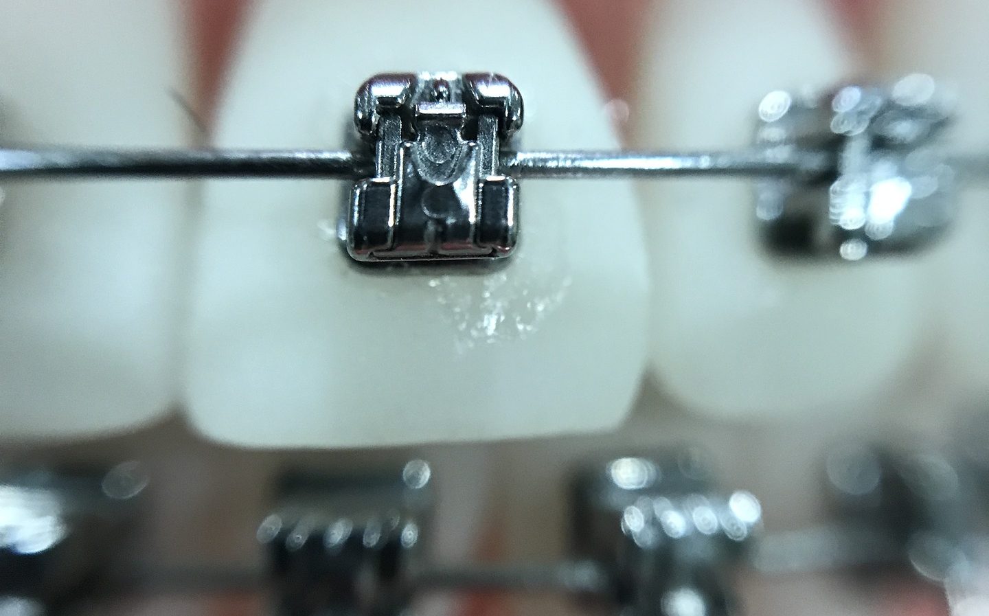 The Different Types Of Braces