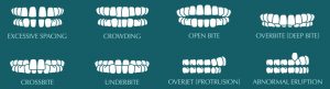 teeth alignment