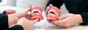 self-ligating braces