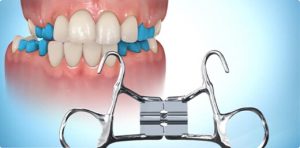 Banded Expander