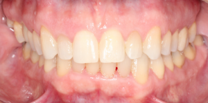 case 4 after