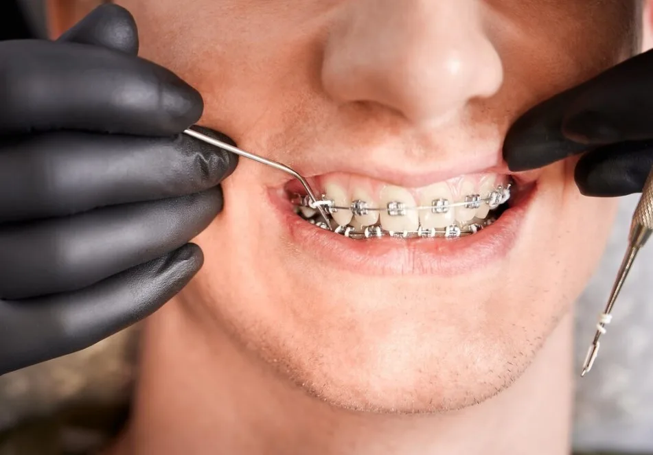 Orthodontic Treatment in Australia