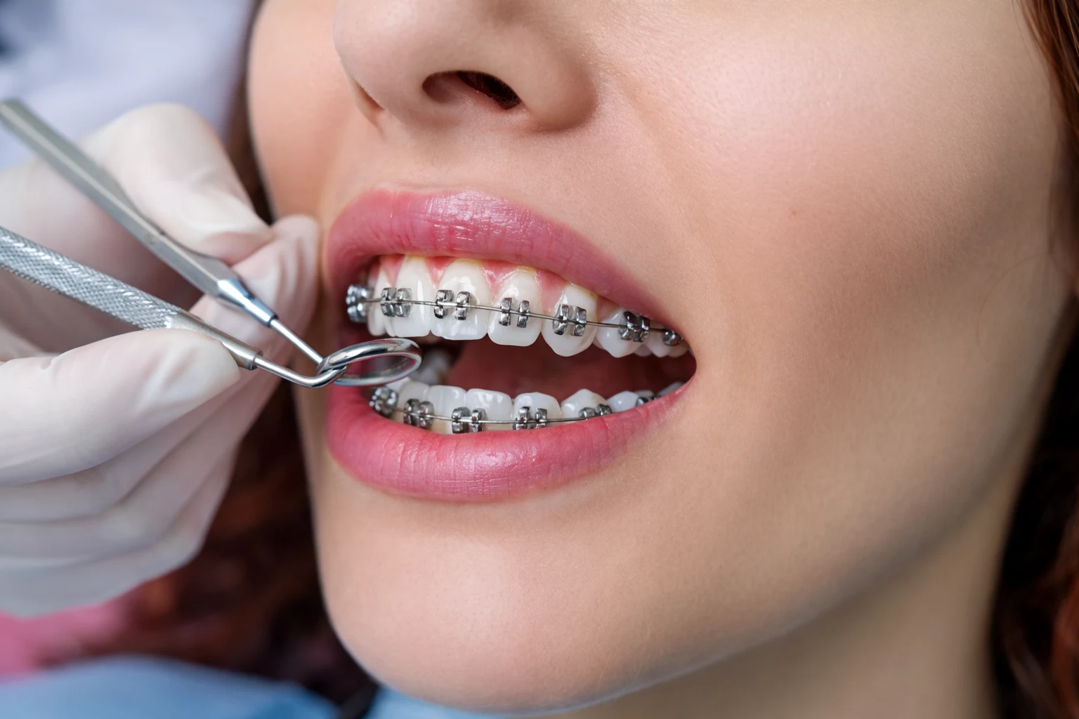 Orthodontist Treatment in Australia