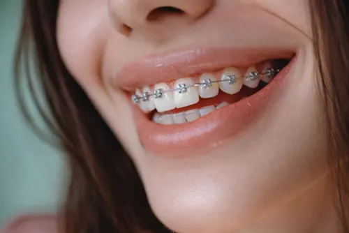 Orthodontics in Carlingford