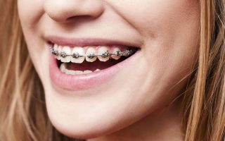 Are braces painful – what can I expect?