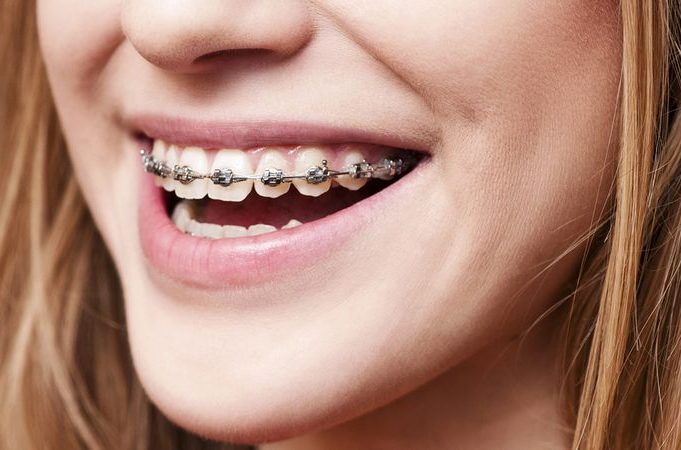 Are braces painful – what can I expect?