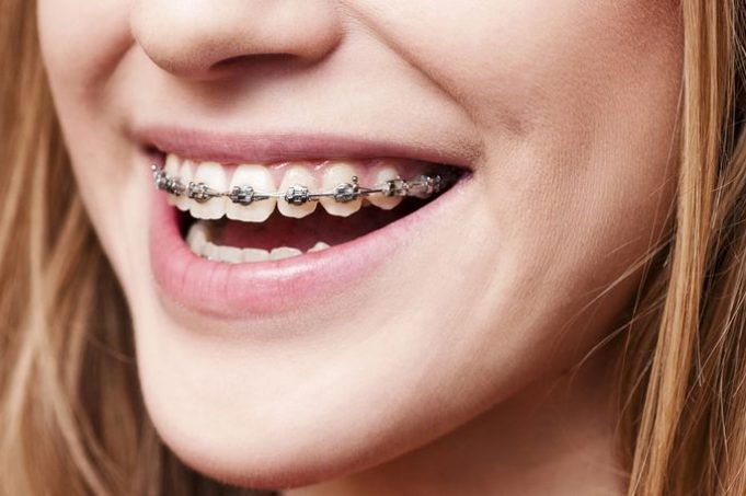 Are braces painful – what can I expect?
