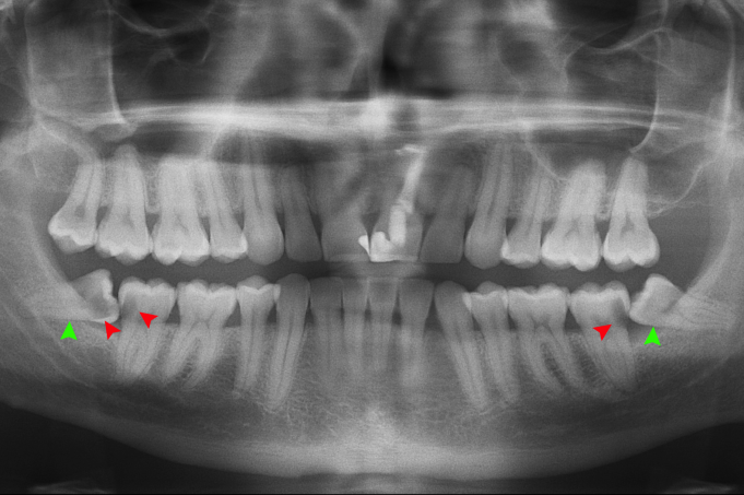 Impacted teeth and orthodontics