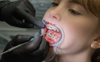 Everything You Need to Know About Modern Orthodontic Options
