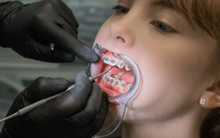Everything You Need to Know About Modern Orthodontic Options
