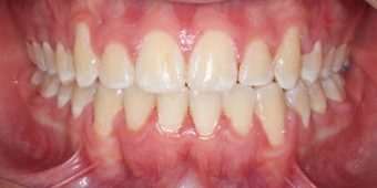 braces for adults
