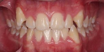 braces for adults