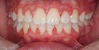 braces for kids