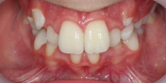braces for kids