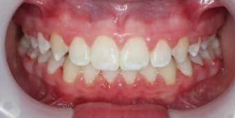 braces for kids