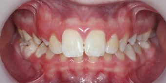 braces for kids