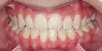 braces for kids
