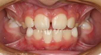 braces for kids