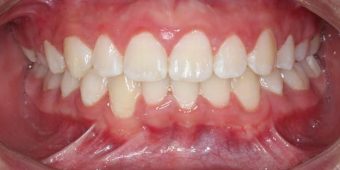 child before braces