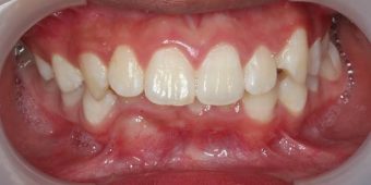 child before braces