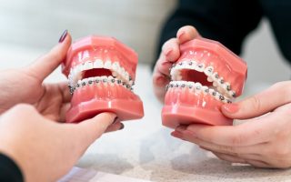 Braces vs. Clear Aligners: Making the Right Choice for Your Smile