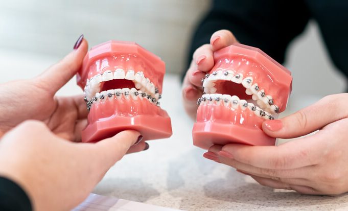 Braces vs. Clear Aligners: Making the Right Choice for Your Smile