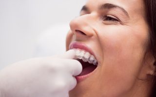 Overbite Correction: Understanding Orthodontic Treatment Options
