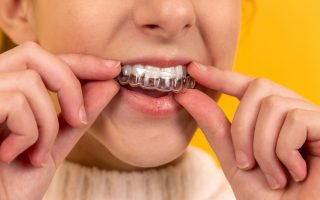 All about Invisalign!
