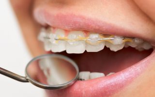 Braces for teenagers – the 101