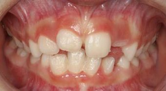 Early Intervention on Orthodontic Issues