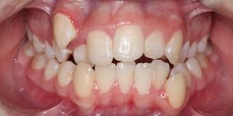 misaligned teeth