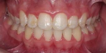 misaligned teeth