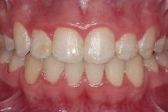 misaligned teeth