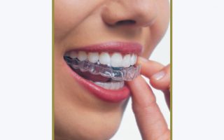 Five tips for the best Invisalign experience