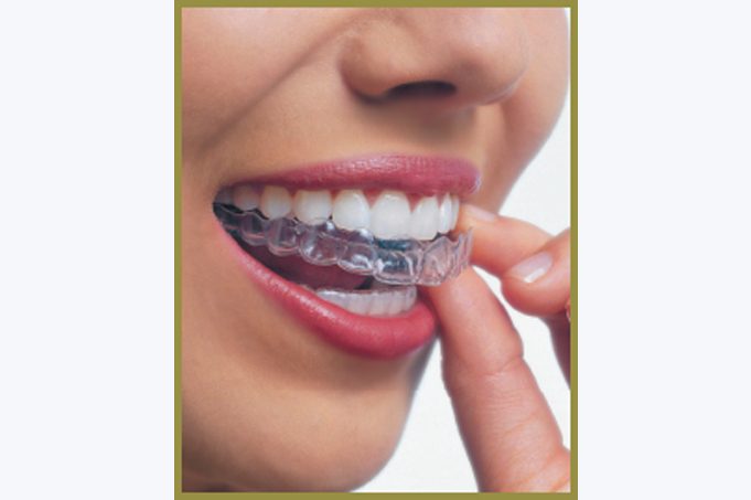 Five tips for the best Invisalign experience