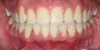 misaligned teeth