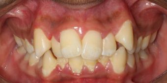 misaligned teeth