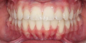 before orthodontics traetment teens