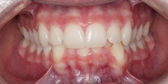 before orthodontics traetment teens