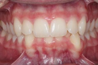 before orthodontics traetment teens