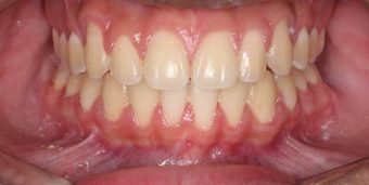 child braces