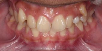 child braces