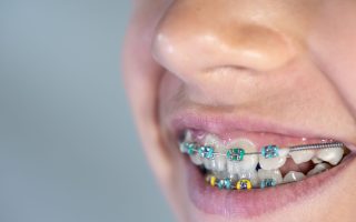 Do Braces Hurt? What to Expect and How to Ease the Pain 