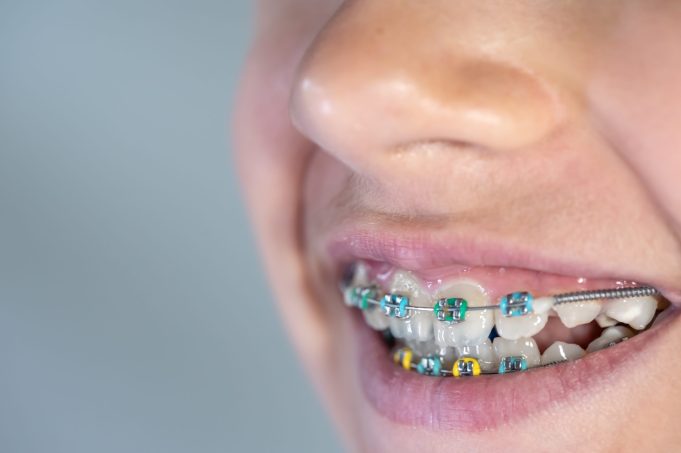 Do Braces Hurt? What to Expect and How to Ease the Pain 