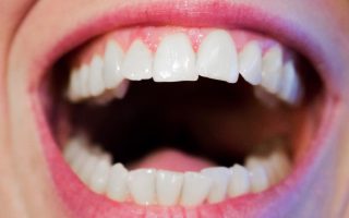 Do I need teeth removed due to crowding?