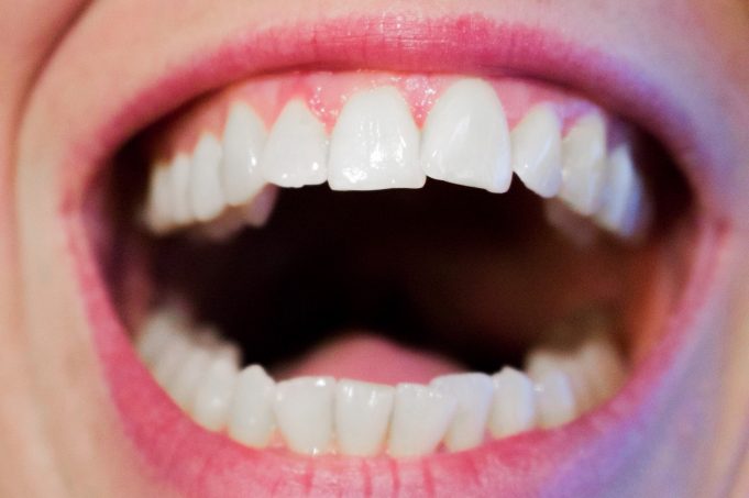 Do I need teeth removed due to crowding?