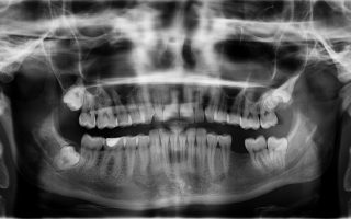 I’m missing a tooth – can an orthodontist help?
