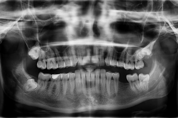 I’m missing a tooth – can an orthodontist help?